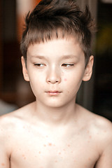 Image showing Boy with chickenpox