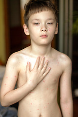 Image showing Boy with chickenpox