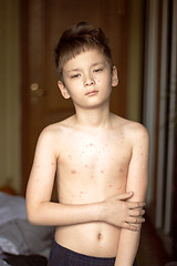 Image showing Boy with chickenpox