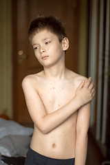 Image showing Boy with chickenpox