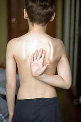 Image showing Boy with chickenpox