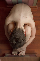 Image showing Boy with chickenpox