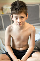 Image showing Boy with chickenpox