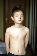 Image showing Boy with chickenpox