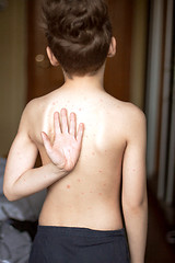 Image showing Boy with chickenpox