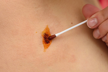 Image showing Antiseptic and disinfectant drug based on iodine is applied to the wound with a cotton wand