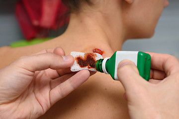 Image showing Antiseptic drug is applied on bandage to treat wounds on the girl\'s neck