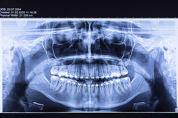 Image showing Dental radiography with braces