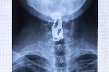 Image showing Radiography of titanium plate to support the cervical spine