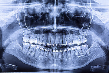 Image showing Dental radiography with braces