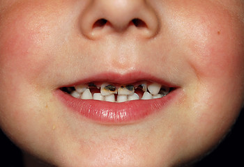 Image showing bad teeth