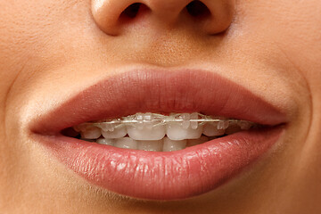 Image showing Beautiful young woman with teeth braces