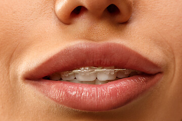 Image showing Beautiful young woman with teeth braces