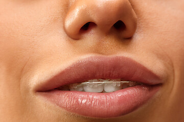 Image showing Beautiful young woman with teeth braces