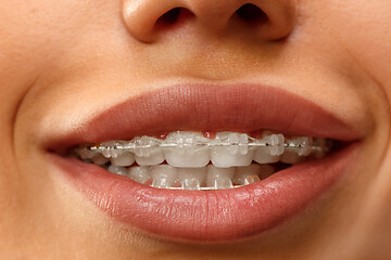 Image showing Beautiful young woman with teeth braces