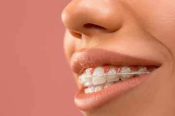 Image showing Beautiful young woman with teeth braces