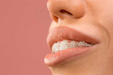 Image showing Beautiful young woman with teeth braces