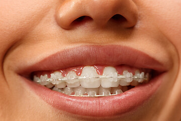 Image showing Beautiful young woman with teeth braces