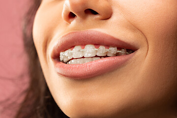 Image showing Beautiful young woman with teeth braces