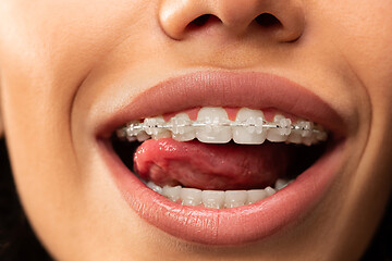 Image showing Beautiful young woman with teeth braces