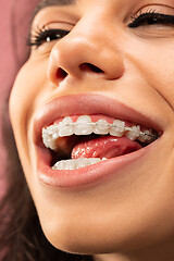 Image showing Beautiful young woman with teeth braces