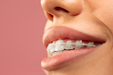 Image showing Beautiful young woman with teeth braces