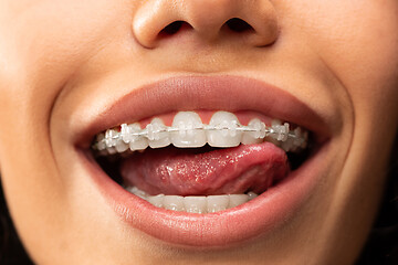 Image showing Beautiful young woman with teeth braces