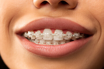 Image showing Beautiful young woman with teeth braces