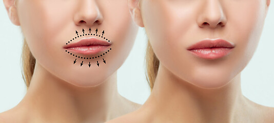 Image showing Before and after lips filler injections. Beauty plastic. Beautiful perfect lips with natural makeup.