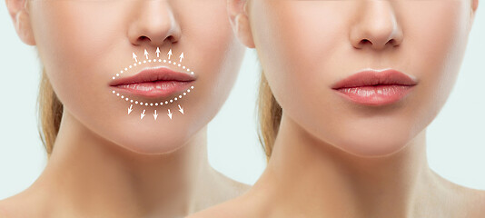 Image showing Before and after lips filler injections. Beauty plastic. Beautiful perfect lips with natural makeup.