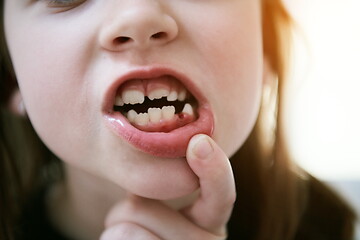 Image showing little girl without tooth smiling