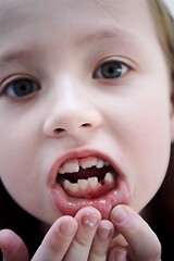 Image showing little girl without tooth smiling