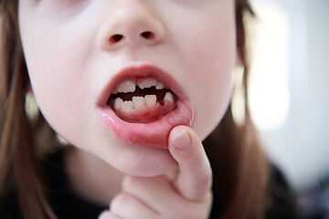 Image showing little girl without tooth smiling