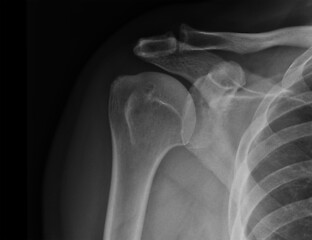 Image showing X-ray shoulder radiograph show state of injury