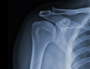 Image showing X-ray shoulder radiograph show state of injury