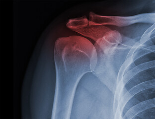 Image showing X-ray shoulder radiograph show state of injury