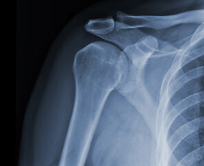 Image showing X-ray shoulder radiograph show state of injury