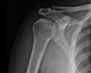 Image showing X-ray shoulder radiograph show state of injury