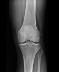 Image showing X-ray knee radiograph show state of injury