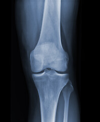 Image showing X-ray knee radiograph show state of injury