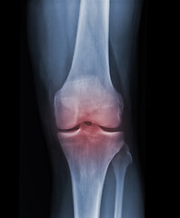 Image showing X-ray knee radiograph show state of injury