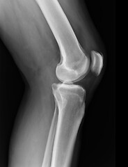 Image showing X-ray knee radiograph show state of injury