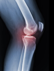 Image showing X-ray knee radiograph show state of injury