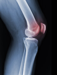 Image showing X-ray knee radiograph show state of injury