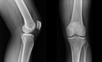 Image showing X-ray knee radiograph show state of injury