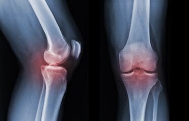 Image showing X-ray knee radiograph show state of injury