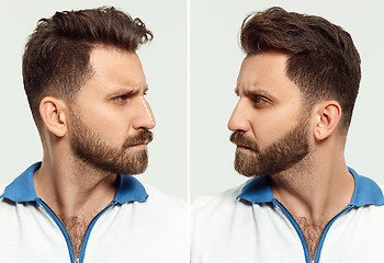 Image showing The male face before and after cosmetic nose surgery. Over white background.