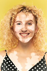 Image showing Studio portrait of caucasian woman with vitiligo skin, beauty concept