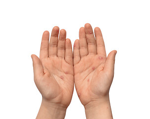 Image showing Children hands with chickenpox