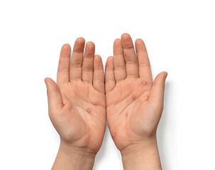 Image showing Children hands with chickenpox